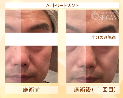 東京 からだのことなら｜肌・頭皮（薄毛）の悩みの改善に「ヒト幹細胞と植物幹細胞による」メディカル系フェイシャルエステケア｜FCR・リアボーテハーブ・ACトリートメント・クレアスキン基礎化粧品の正規取扱いサロンです。ニキビ・ニキビ跡（痕）・クレーター・色素沈着・シワ・シミ・たるみ・毛穴のお悩みに肌質改善を|ビフォーアフター写真