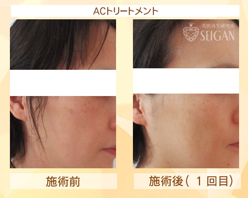 東京 からだのことなら｜肌・頭皮（薄毛）の悩みの改善に「ヒト幹細胞と植物幹細胞による」メディカル系フェイシャルエステケア｜FCR・リアボーテハーブ・ACトリートメント・クレアスキン基礎化粧品の正規取扱いサロンです。ニキビ・ニキビ跡（痕）・クレーター・色素沈着・シワ・シミ・たるみ・毛穴のお悩みに肌質改善を|ビフォーアフター写真