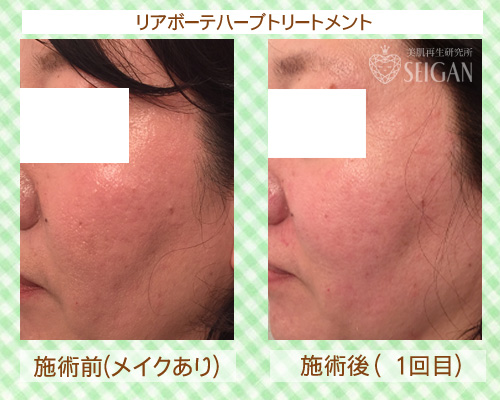 東京 三軒茶屋 からだのことなら|肌・頭皮(薄毛)の悩みの改善に「ヒト幹細胞と植物幹細胞による」メディカル系フェイシャルエステケア|FCR・リアボーテハーブ・ACトリートメント・クレアスキン基礎化粧品の正規取扱いサロンです。ニキビ・ニキビ跡(痕)・クレーター・色素沈着・シワ・シミ・たるみ・毛穴のお悩みに肌質改善を ビフォーアフター症例写真