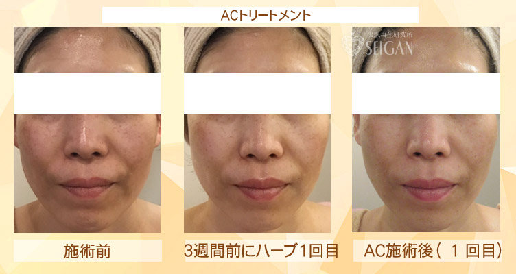 東京 からだのことなら｜肌・頭皮（薄毛）の悩みの改善に「ヒト幹細胞と植物幹細胞による」メディカル系フェイシャルエステケア｜FCR・リアボーテハーブ・ACトリートメント・クレアスキン基礎化粧品の正規取扱いサロンです。ニキビ・ニキビ跡（痕）・クレーター・色素沈着・シワ・シミ・たるみ・毛穴のお悩みに肌質改善を　ビフォーアフター症例写真