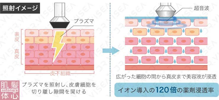 広がった細胞の間から真皮まで美容液が浸透　イオン導入の120倍の薬剤浸透率｜≪高濃度ヒト幹細胞培養液/iPSフェイシャル専門エステサロン≫ iPS BioCellCare AnnaCarna アンナカルナ【シミケア専科 プラズマ O:Celloオセロ 東京店 併設】肌質改善☆年齢肌☆小顔矯正☆シミ取り専門☆プラズマシミ取り放題◆プラズマシャワー・プラズマミスト・プラズマニードル◆芸能人ご用達コスメ「リアボーテ化粧品」正規販売店・クレアスキン・グランスキン・シェリースキン・エキスパートローション・リアムール・健美草◆購入方法・口コミ・効果・使い方・ビフォーアフター・動画・写真・通販・ネット販売対象外商品｜港区 南青山 銀座線 外苑前駅・青山一丁目駅◆個室完備・医療提携サロン・メディカルエステ