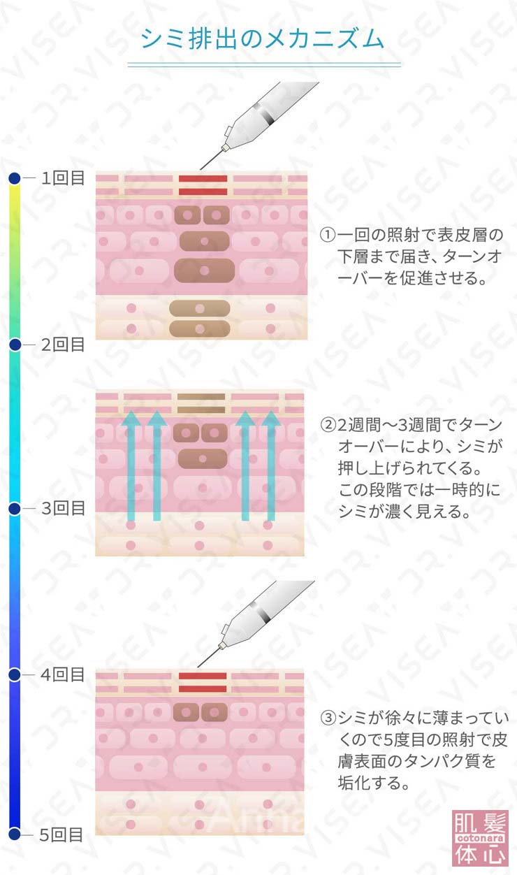 シミ排出のメカニズム｜≪高濃度ヒト幹細胞培養液/iPSフェイシャル専門エステサロン≫ iPS BioCellCare AnnaCarna アンナカルナ【シミケア専科 プラズマ O:Celloオセロ 東京店 併設】肌質改善☆年齢肌☆小顔矯正☆シミ取り専門☆プラズマシミ取り放題◆プラズマシャワー・プラズマミスト・プラズマニードル◆芸能人ご用達コスメ「リアボーテ化粧品」正規販売店・クレアスキン・グランスキン・シェリースキン・エキスパートローション・リアムール・健美草◆購入方法・口コミ・効果・使い方・ビフォーアフター・動画・写真・通販・ネット販売対象外商品｜港区 南青山 銀座線 外苑前駅・青山一丁目駅◆個室完備・医療提携サロン・メディカルエステ