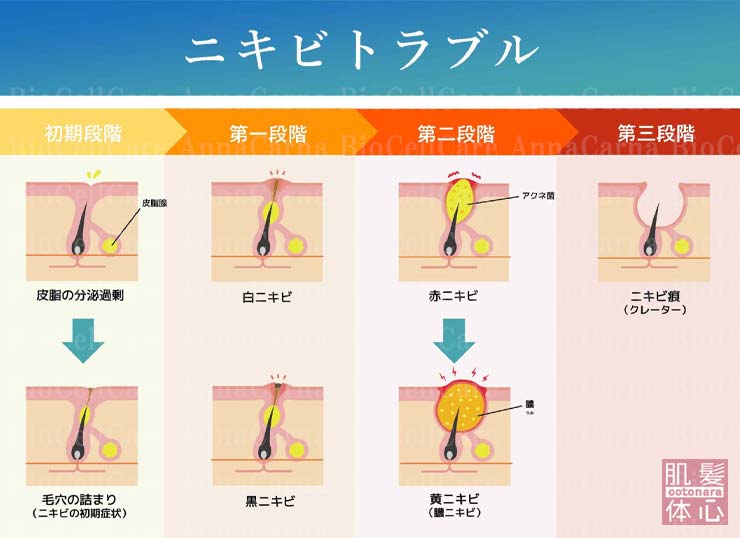 ニキビトラブル｜≪高濃度ヒト幹細胞培養液/iPSフェイシャル専門エステサロン≫ iPS BioCellCare AnnaCarna アンナカルナ【シミケア専科 プラズマ O:Celloオセロ 東京店 併設】肌質改善☆年齢肌☆小顔矯正☆シミ取り専門☆プラズマシミ取り放題◆プラズマシャワー・プラズマミスト・プラズマニードル◆芸能人ご用達コスメ「リアボーテ化粧品」正規販売店・クレアスキン・グランスキン・シェリースキン・エキスパートローション・リアムール・健美草◆購入方法・口コミ・効果・使い方・ビフォーアフター・動画・写真・通販・ネット販売対象外商品｜港区 南青山 銀座線 外苑前駅・青山一丁目駅◆個室完備・医療提携サロン・メディカルエステ