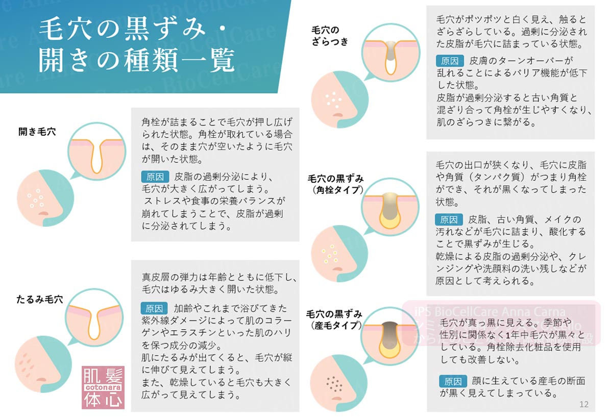 毛穴の黒ずみと開きの種類｜≪高濃度ヒト幹細胞培養液/iPSフェイシャル専門エステサロン≫ iPS BioCellCare AnnaCarna アンナカルナ【シミケア専科 プラズマ O:Celloオセロ 東京店 併設】肌質改善☆年齢肌☆小顔矯正☆シミ取り専門☆プラズマシミ取り放題◆プラズマシャワー・プラズマミスト・プラズマニードル◆芸能人ご用達コスメ「リアボーテ化粧品」正規販売店・クレアスキン・グランスキン・シェリースキン・エキスパートローション・リアムール・健美草◆購入方法・口コミ・効果・使い方・ビフォーアフター・動画・写真・通販・ネット販売対象外商品｜港区 南青山 銀座線 外苑前駅・青山一丁目駅◆個室完備・医療提携サロン・メディカルエステ