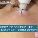 プラズマシミケア放題（レーザーシミ取り放題が不安な方にもおススメ）｜≪高濃度ヒト幹細胞培養液/iPSフェイシャル専門エステサロン≫ iPS BioCellCare AnnaCarna アンナカルナ【シミケア専科 プラズマ O:Celloオセロ 東京店 併設】肌質改善☆年齢肌☆小顔矯正☆シミ取り専門◆プラズマシャワー・プラズマミスト・プラズマニードル◆芸能人ご用達コスメ「リアボーテ化粧品」正規販売店・クレアスキン・グランスキン・シェリースキン・エキスパートローション・リアムール・健美草◆購入方法・口コミ・効果・使い方・ビフォーアフター・動画・写真・通販・ネット販売対象外商品｜港区 南青山 銀座線 外苑前駅・青山一丁目駅◆個室完備・医療提携サロン・メディカルエステ