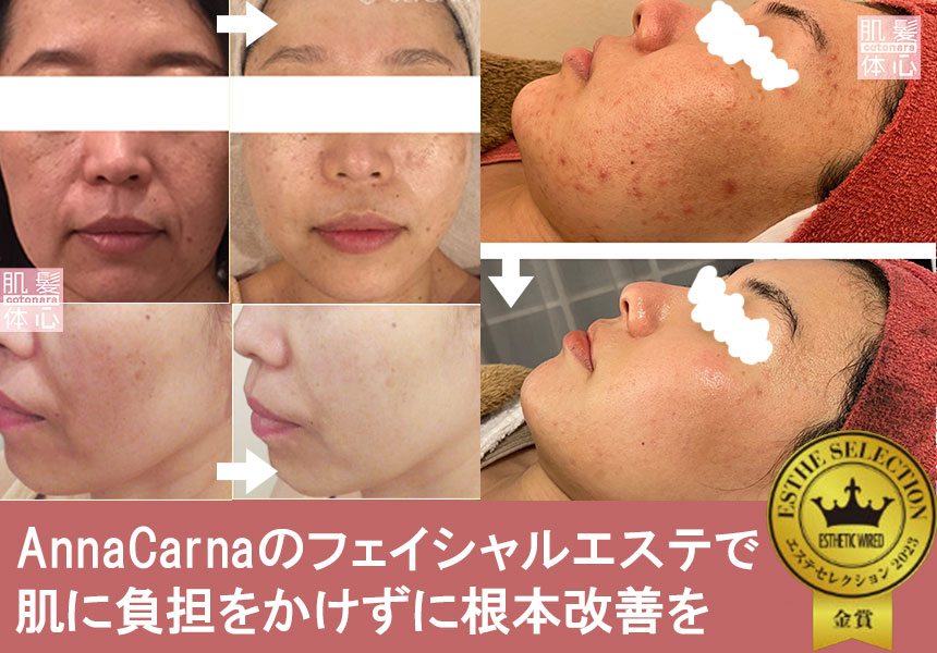 ビフォーアフター口コミ写真|【高濃度ヒト幹細胞/iPSフェイシャル専門】ビューティースキンラボ Anna Carna 【リピ率9割超】≪肌質改善☆年齢肌☆小顔矯正 フェイシャルエステ/iPS×ヒト幹細胞≫◆芸能人ご用達の幹細胞コスメブランド「リアボーテ」専門店☆乾燥じわ・シミ・肌荒れ・毛穴・たるみ・目の下のクマ・くすみケア☆悩み特化型メニューで透明感のあるすっぴん美肌へ☆高い技術力、知識、穏やかな人柄が「ずっと通いたいサロン」と評判に★リアボーテクレアスキン化粧品・リアボーテグランスキン化粧品・リアボーテシェリースキン化粧品・エキスパートローション・アコライム・リアムール化粧品・エクラボーテ美顔器 正規取扱店|口コミ・効果・使い方・ビフォーアフター・動画・写真・方法・通販・ネット販売・対象外商品★イネイト活性療法 整体院併設★東京都 港区 南青山 銀座線 外苑前駅 徒歩2分 個室完備