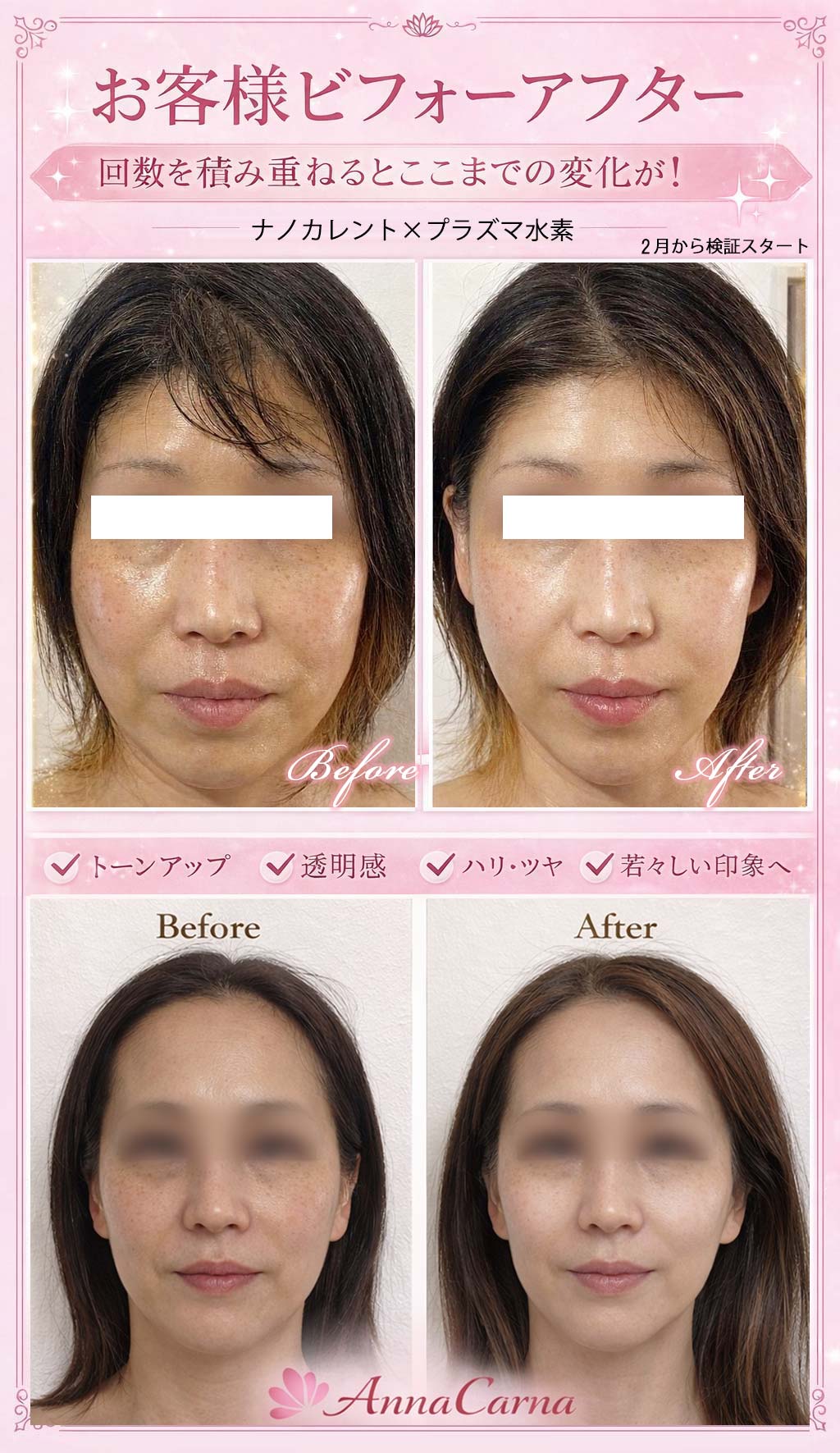 ビフォーアフター リアボーテ医療提携サロン AnnaCarna（アンナカルナ）による美容医療前の組織環境調整ナノカレント全顔リフトアップとラフォス深部加温の施術イメージ