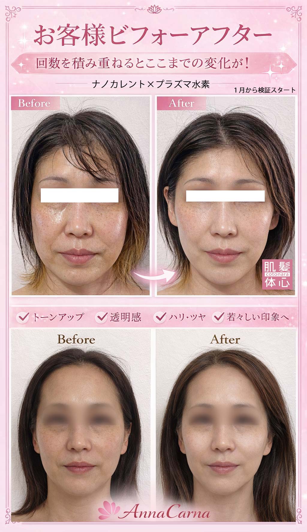 フェイスラインのたるみを整えるナノカレント全顔施術 ビフォーアフター写真|ほうれい線・輪郭ケア FACE RE:DESIGN