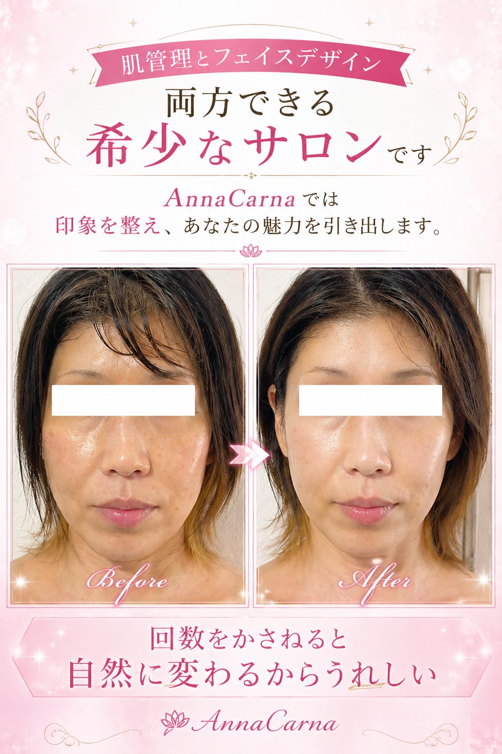 ナノカレントビフォーアフター写真｜芸能人ご用達・幹細胞コスメブランド・リアボーテ専門エステ・リアボーテ医療提携サロン AnnaCarna・リアボーテクレアスキン化粧品・リアボーテグランスキン化粧品・リアボーテシェリースキン化粧品・エキスパートローション・リアムール化粧品・エクラボーテ美顔器・正規取扱店・高濃度ヒト幹細胞培養液・ヒト幹細胞培養液・フェイシャル・ips細胞・ナノカレント・微弱電流・コラーゲン生成・筋膜・血流改善・リンパ・自律神経・再生美容・フェイスデザイン・リフトアップ・小顔・たるみケア・ほうれい線・マリオネットライン・フェイスラインもたつき・二重あご・目の下たるみ・クマ・青クマ・茶クマ・黒クマ・シミ・シミ取り・肝斑・色素沈着・ニキビ・ニキビ跡・毛穴・開き毛穴・たるみ毛穴・赤み・くすみ・乾燥・敏感肌・乾燥小じわ・ハリ・ツヤ・肌質改善・エイジングケア・年齢肌・頭活・頭皮ケア・育毛ケア・口コミ・評判・効果・使い方・ビフォーアフター・症例・動画・写真・施術方法・スキンケア方法・予約・当日予約・空き状況・料金・価格・体験・初回・再来・コース・メニュー・比較・おすすめ・人気・購入方法・販売店・正規販売・オンラインカウンセリング・発送対応・通販・ネット販売・禁止・対象外商品・カウンセリング必須・医療提携・専門サロン・完全個室・都度払い・勧誘なし・症例多数・実績・紹介・青山・港区・外苑前・東京・大阪・阿倍野区