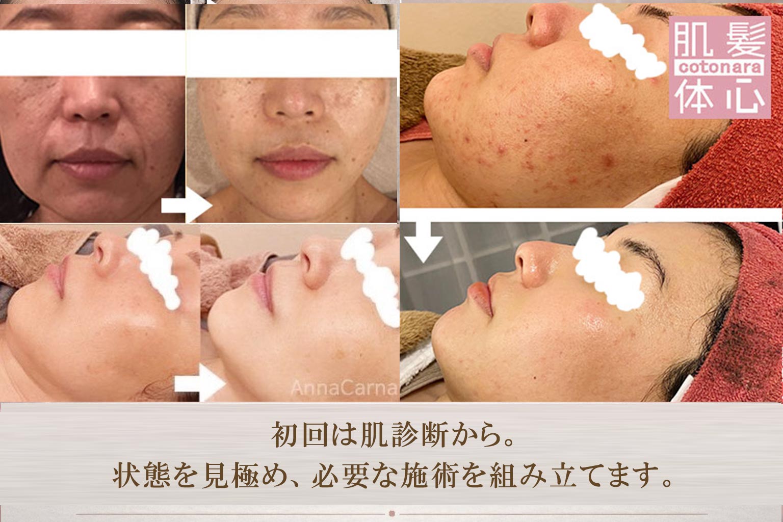 ビフォーアフター｜芸能人ご用達・幹細胞コスメブランド・リアボーテ専門エステ・リアボーテ医療提携サロン AnnaCarna・リアボーテクレアスキン化粧品・リアボーテグランスキン化粧品・リアボーテシェリースキン化粧品・エキスパートローション・リアムール化粧品・エクラボーテ美顔器・正規取扱店・高濃度ヒト幹細胞培養液・ヒト幹細胞培養液・フェイシャル・ips細胞・ナノカレント・微弱電流・コラーゲン生成・筋膜・血流改善・リンパ・自律神経・再生美容・フェイスデザイン・リフトアップ・小顔・たるみケア・ほうれい線・マリオネットライン・フェイスラインもたつき・二重あご・目の下たるみ・クマ・青クマ・茶クマ・黒クマ・シミ・シミ取り・肝斑・色素沈着・ニキビ・ニキビ跡・毛穴・開き毛穴・たるみ毛穴・赤み・くすみ・乾燥・敏感肌・乾燥小じわ・ハリ・ツヤ・肌質改善・エイジングケア・年齢肌・頭活・頭皮ケア・育毛ケア・口コミ・評判・効果・使い方・ビフォーアフター・症例・動画・写真・施術方法・スキンケア方法・予約・当日予約・空き状況・料金・価格・体験・初回・再来・コース・メニュー・比較・おすすめ・人気・購入方法・販売店・正規販売・オンラインカウンセリング・発送対応・通販・ネット販売・禁止・対象外商品・カウンセリング必須・医療提携・専門サロン・完全個室・都度払い・勧誘なし・症例多数・実績・紹介・青山・港区・外苑前・東京・大阪・阿倍野区