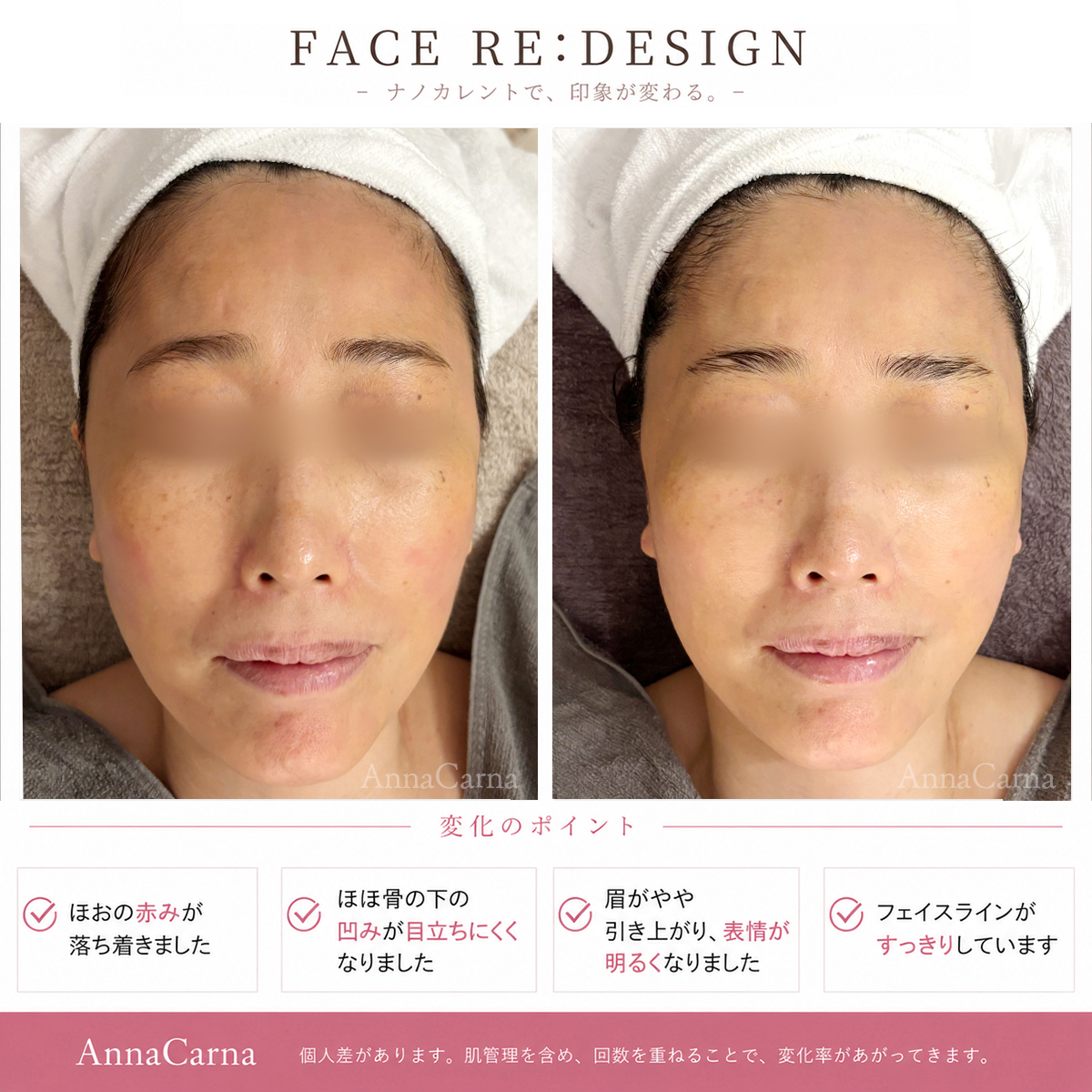 FACE RE:DESIGN ナノカレント全顔リフトアップ施術のビフォーアフター｜南青山AnnaCarna