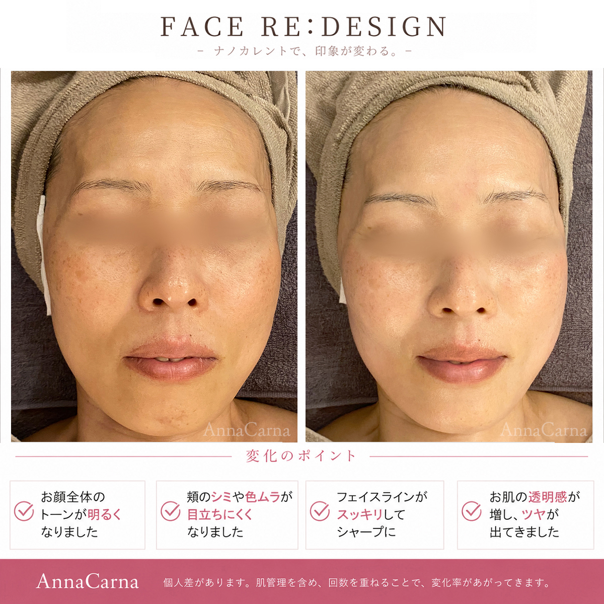 FACE RE:DESIGN ナノカレント全顔リフトアップ施術のビフォーアフター|南青山AnnaCarna