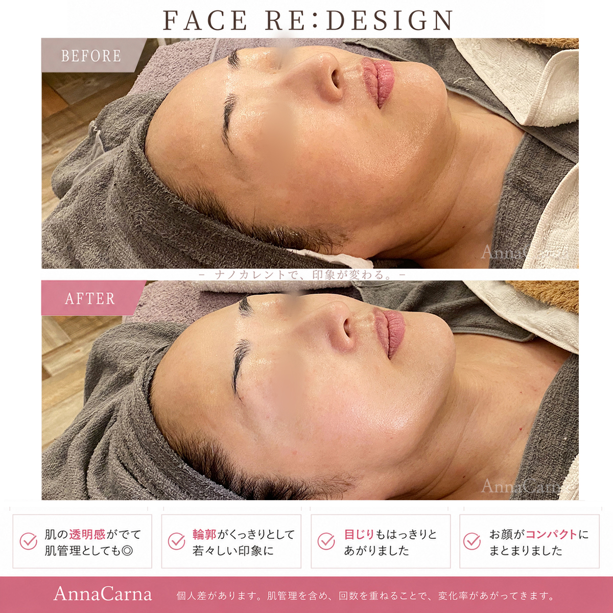 FACE RE:DESIGN ナノカレント全顔リフトアップ施術のビフォーアフター｜南青山AnnaCarna
