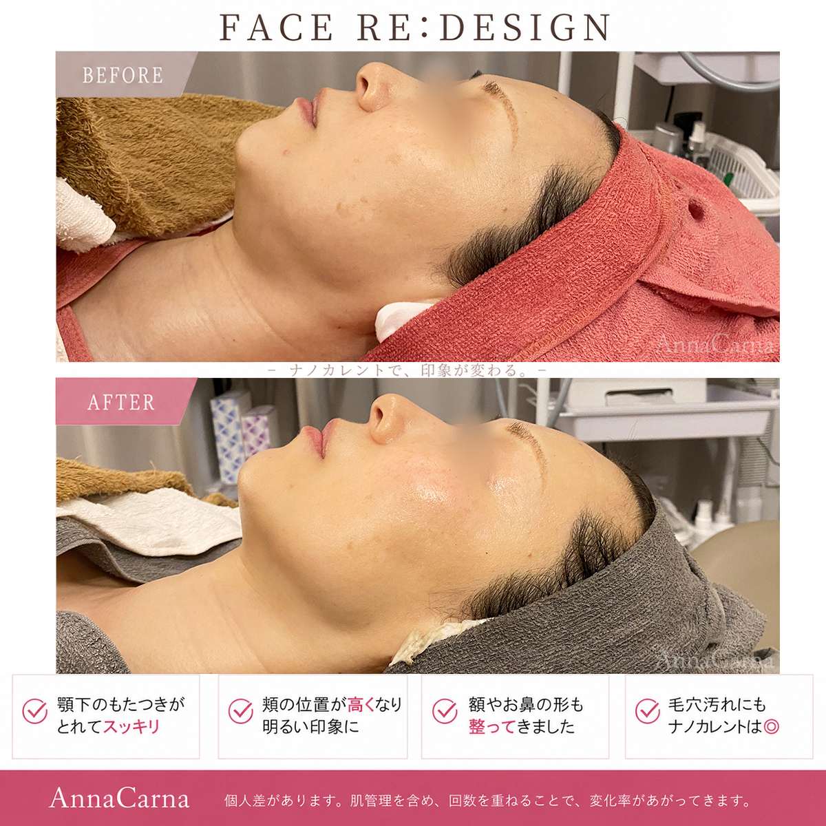 FACE RE:DESIGN ナノカレント全顔リフトアップ施術のビフォーアフター｜南青山AnnaCarna