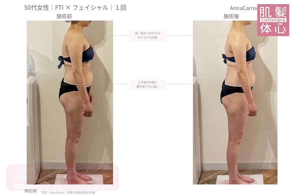 50代女性・FTIとフェイシャル１回の施術前後を横姿で比較｜美容家や芸能人ご用達・幹細胞コスメブランド・リアボーテ専門エステ・リアボーテ医療提携サロン AnnaCarna・リアボーテクレアスキン化粧品・リアボーテグランスキン化粧品・リアボーテシェリースキン化粧品・エキスパートローション・リアムール化粧品・エクラボーテ美顔器・正規取扱店・高濃度ヒト幹細胞培養液・ヒト幹細胞培養液・フェイシャル・ips細胞・ナノカレント・微弱電流・コラーゲン生成・筋膜・血流改善・リンパ・自律神経・再生美容・フェイスデザイン・リフトアップ・小顔・たるみケア・ほうれい線・マリオネットライン・フェイスラインもたつき・二重あご・目の下たるみ・クマ・青クマ・茶クマ・黒クマ・シミ・シミ取り・肝斑・色素沈着・ニキビ・ニキビ跡・毛穴・開き毛穴・たるみ毛穴・赤み・くすみ・乾燥・敏感肌・乾燥小じわ・ハリ・ツヤ・肌質改善・エイジングケア・年齢肌・頭活・頭皮ケア・育毛ケア・口コミ・評判・効果・使い方・ビフォーアフター・症例・動画・写真・施術方法・スキンケア方法・予約・当日予約・空き状況・料金・価格・体験・初回・再来・コース・メニュー・比較・おすすめ・人気・購入方法・販売店・正規販売・オンラインカウンセリング・発送対応・通販・ネット販売・禁止・対象外商品・カウンセリング必須・医療提携・専門サロン・完全個室・都度払い・勧誘なし・症例多数・実績・紹介・青山・港区・外苑前・東京・大阪・阿倍野区