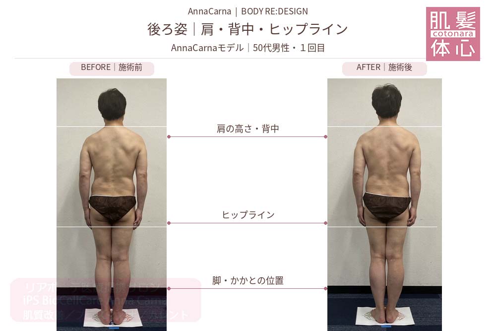 AnnaCarnaモデル・50代男性１回目の施術前後比較／後ろ姿：背中・ヒップライン｜美容家や芸能人ご用達・幹細胞コスメブランド・リアボーテ専門エステ・リアボーテ医療提携サロン AnnaCarna・リアボーテクレアスキン化粧品・リアボーテグランスキン化粧品・リアボーテシェリースキン化粧品・エキスパートローション・リアムール化粧品・エクラボーテ美顔器・正規取扱店・高濃度ヒト幹細胞培養液・ヒト幹細胞培養液・フェイシャル・ips細胞・ナノカレント・微弱電流・コラーゲン生成・筋膜・血流改善・リンパ・自律神経・再生美容・フェイスデザイン・リフトアップ・小顔・たるみケア・ほうれい線・マリオネットライン・フェイスラインもたつき・二重あご・目の下たるみ・クマ・青クマ・茶クマ・黒クマ・シミ・シミ取り・肝斑・色素沈着・ニキビ・ニキビ跡・毛穴・開き毛穴・たるみ毛穴・赤み・くすみ・乾燥・敏感肌・乾燥小じわ・ハリ・ツヤ・肌質改善・エイジングケア・年齢肌・頭活・頭皮ケア・育毛ケア・口コミ・評判・効果・使い方・ビフォーアフター・症例・動画・写真・施術方法・スキンケア方法・予約・当日予約・空き状況・料金・価格・体験・初回・再来・コース・メニュー・比較・おすすめ・人気・購入方法・販売店・正規販売・オンラインカウンセリング・発送対応・通販・ネット販売・禁止・対象外商品・カウンセリング必須・医療提携・専門サロン・完全個室・都度払い・勧誘なし・症例多数・実績・紹介・青山・港区・外苑前・東京・大阪・阿倍野区