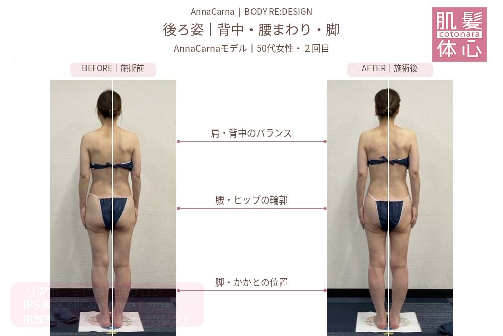 AnnaCarnaモデル・50代女性２回目の施術前後比較／後ろ姿：背中・腰まわり・脚｜美容家や芸能人ご用達・幹細胞コスメブランド・リアボーテ専門エステ・リアボーテ医療提携サロン AnnaCarna・リアボーテクレアスキン化粧品・リアボーテグランスキン化粧品・リアボーテシェリースキン化粧品・エキスパートローション・リアムール化粧品・エクラボーテ美顔器・正規取扱店・高濃度ヒト幹細胞培養液・ヒト幹細胞培養液・フェイシャル・ips細胞・ナノカレント・微弱電流・コラーゲン生成・筋膜・血流改善・リンパ・自律神経・再生美容・フェイスデザイン・リフトアップ・小顔・たるみケア・ほうれい線・マリオネットライン・フェイスラインもたつき・二重あご・目の下たるみ・クマ・青クマ・茶クマ・黒クマ・シミ・シミ取り・肝斑・色素沈着・ニキビ・ニキビ跡・毛穴・開き毛穴・たるみ毛穴・赤み・くすみ・乾燥・敏感肌・乾燥小じわ・ハリ・ツヤ・肌質改善・エイジングケア・年齢肌・頭活・頭皮ケア・育毛ケア・口コミ・評判・効果・使い方・ビフォーアフター・症例・動画・写真・施術方法・スキンケア方法・予約・当日予約・空き状況・料金・価格・体験・初回・再来・コース・メニュー・比較・おすすめ・人気・購入方法・販売店・正規販売・オンラインカウンセリング・発送対応・通販・ネット販売・禁止・対象外商品・カウンセリング必須・医療提携・専門サロン・完全個室・都度払い・勧誘なし・症例多数・実績・紹介・青山・港区・外苑前・東京・大阪・阿倍野区