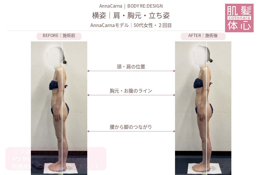AnnaCarnaモデル・50代女性２回目の施術前後比較／横姿：首・肩・胸元と立ち姿｜美容家や芸能人ご用達・幹細胞コスメブランド・リアボーテ専門エステ・リアボーテ医療提携サロン AnnaCarna・リアボーテクレアスキン化粧品・リアボーテグランスキン化粧品・リアボーテシェリースキン化粧品・エキスパートローション・リアムール化粧品・エクラボーテ美顔器・正規取扱店・高濃度ヒト幹細胞培養液・ヒト幹細胞培養液・フェイシャル・ips細胞・ナノカレント・微弱電流・コラーゲン生成・筋膜・血流改善・リンパ・自律神経・再生美容・フェイスデザイン・リフトアップ・小顔・たるみケア・ほうれい線・マリオネットライン・フェイスラインもたつき・二重あご・目の下たるみ・クマ・青クマ・茶クマ・黒クマ・シミ・シミ取り・肝斑・色素沈着・ニキビ・ニキビ跡・毛穴・開き毛穴・たるみ毛穴・赤み・くすみ・乾燥・敏感肌・乾燥小じわ・ハリ・ツヤ・肌質改善・エイジングケア・年齢肌・頭活・頭皮ケア・育毛ケア・口コミ・評判・効果・使い方・ビフォーアフター・症例・動画・写真・施術方法・スキンケア方法・予約・当日予約・空き状況・料金・価格・体験・初回・再来・コース・メニュー・比較・おすすめ・人気・購入方法・販売店・正規販売・オンラインカウンセリング・発送対応・通販・ネット販売・禁止・対象外商品・カウンセリング必須・医療提携・専門サロン・完全個室・都度払い・勧誘なし・症例多数・実績・紹介・青山・港区・外苑前・東京・大阪・阿倍野区