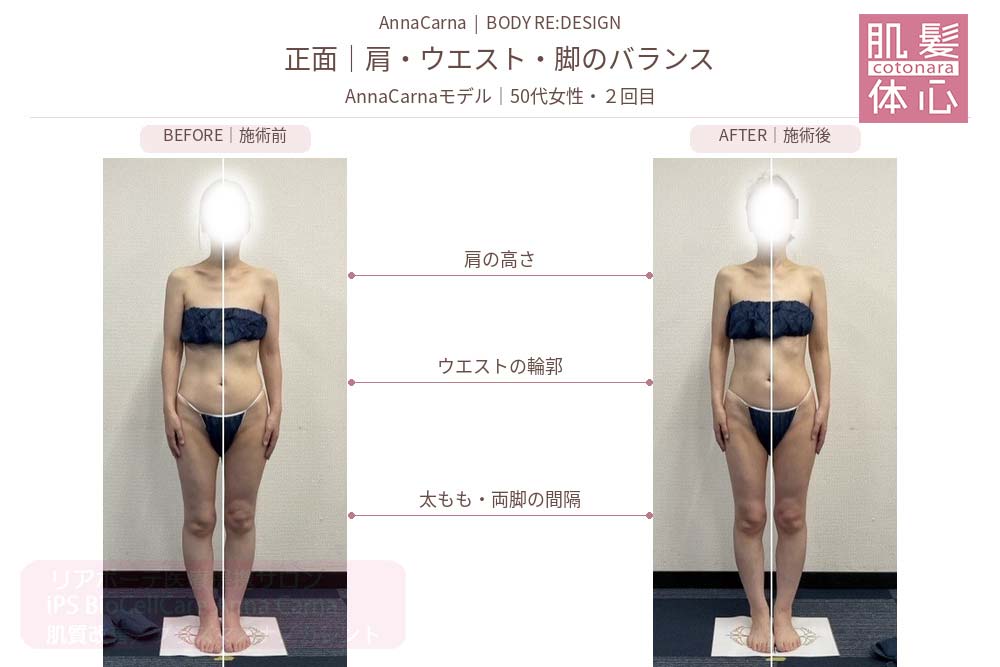 AnnaCarnaモデル・50代女性２回目の施術前後比較／正面：肩・ウエスト・脚のバランス｜美容家や芸能人ご用達・幹細胞コスメブランド・リアボーテ専門エステ・リアボーテ医療提携サロン AnnaCarna・リアボーテクレアスキン化粧品・リアボーテグランスキン化粧品・リアボーテシェリースキン化粧品・エキスパートローション・リアムール化粧品・エクラボーテ美顔器・正規取扱店・高濃度ヒト幹細胞培養液・ヒト幹細胞培養液・フェイシャル・ips細胞・ナノカレント・微弱電流・コラーゲン生成・筋膜・血流改善・リンパ・自律神経・再生美容・フェイスデザイン・リフトアップ・小顔・たるみケア・ほうれい線・マリオネットライン・フェイスラインもたつき・二重あご・目の下たるみ・クマ・青クマ・茶クマ・黒クマ・シミ・シミ取り・肝斑・色素沈着・ニキビ・ニキビ跡・毛穴・開き毛穴・たるみ毛穴・赤み・くすみ・乾燥・敏感肌・乾燥小じわ・ハリ・ツヤ・肌質改善・エイジングケア・年齢肌・頭活・頭皮ケア・育毛ケア・口コミ・評判・効果・使い方・ビフォーアフター・症例・動画・写真・施術方法・スキンケア方法・予約・当日予約・空き状況・料金・価格・体験・初回・再来・コース・メニュー・比較・おすすめ・人気・購入方法・販売店・正規販売・オンラインカウンセリング・発送対応・通販・ネット販売・禁止・対象外商品・カウンセリング必須・医療提携・専門サロン・完全個室・都度払い・勧誘なし・症例多数・実績・紹介・青山・港区・外苑前・東京・大阪・阿倍野区