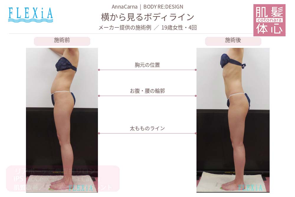 FTIナノカレントビフォーアフター写真｜美容家や芸能人ご用達・幹細胞コスメブランド・リアボーテ専門エステ・リアボーテ医療提携サロン AnnaCarna・リアボーテクレアスキン化粧品・リアボーテグランスキン化粧品・リアボーテシェリースキン化粧品・エキスパートローション・リアムール化粧品・エクラボーテ美顔器・正規取扱店・高濃度ヒト幹細胞培養液・ヒト幹細胞培養液・フェイシャル・ips細胞・ナノカレント・微弱電流・コラーゲン生成・筋膜・血流改善・リンパ・自律神経・再生美容・フェイスデザイン・リフトアップ・小顔・たるみケア・ほうれい線・マリオネットライン・フェイスラインもたつき・二重あご・目の下たるみ・クマ・青クマ・茶クマ・黒クマ・シミ・シミ取り・肝斑・色素沈着・ニキビ・ニキビ跡・毛穴・開き毛穴・たるみ毛穴・赤み・くすみ・乾燥・敏感肌・乾燥小じわ・ハリ・ツヤ・肌質改善・エイジングケア・年齢肌・頭活・頭皮ケア・育毛ケア・口コミ・評判・効果・使い方・ビフォーアフター・症例・動画・写真・施術方法・スキンケア方法・予約・当日予約・空き状況・料金・価格・体験・初回・再来・コース・メニュー・比較・おすすめ・人気・購入方法・販売店・正規販売・オンラインカウンセリング・発送対応・通販・ネット販売・禁止・対象外商品・カウンセリング必須・医療提携・専門サロン・完全個室・都度払い・勧誘なし・症例多数・実績・紹介・青山・港区・外苑前・東京・大阪・阿倍野区