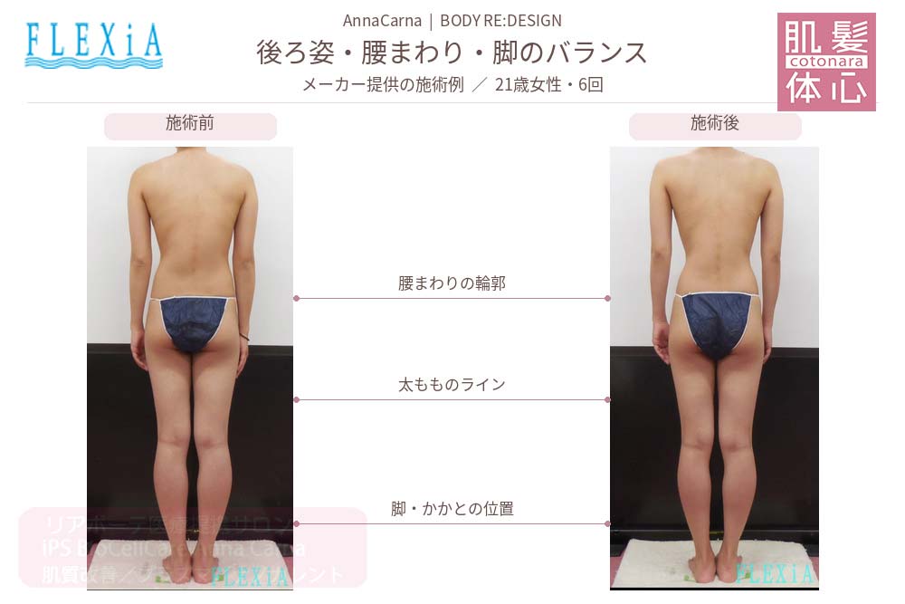 FTIナノカレントビフォーアフター写真｜美容家や芸能人ご用達・幹細胞コスメブランド・リアボーテ専門エステ・リアボーテ医療提携サロン AnnaCarna・リアボーテクレアスキン化粧品・リアボーテグランスキン化粧品・リアボーテシェリースキン化粧品・エキスパートローション・リアムール化粧品・エクラボーテ美顔器・正規取扱店・高濃度ヒト幹細胞培養液・ヒト幹細胞培養液・フェイシャル・ips細胞・ナノカレント・微弱電流・コラーゲン生成・筋膜・血流改善・リンパ・自律神経・再生美容・フェイスデザイン・リフトアップ・小顔・たるみケア・ほうれい線・マリオネットライン・フェイスラインもたつき・二重あご・目の下たるみ・クマ・青クマ・茶クマ・黒クマ・シミ・シミ取り・肝斑・色素沈着・ニキビ・ニキビ跡・毛穴・開き毛穴・たるみ毛穴・赤み・くすみ・乾燥・敏感肌・乾燥小じわ・ハリ・ツヤ・肌質改善・エイジングケア・年齢肌・頭活・頭皮ケア・育毛ケア・口コミ・評判・効果・使い方・ビフォーアフター・症例・動画・写真・施術方法・スキンケア方法・予約・当日予約・空き状況・料金・価格・体験・初回・再来・コース・メニュー・比較・おすすめ・人気・購入方法・販売店・正規販売・オンラインカウンセリング・発送対応・通販・ネット販売・禁止・対象外商品・カウンセリング必須・医療提携・専門サロン・完全個室・都度払い・勧誘なし・症例多数・実績・紹介・青山・港区・外苑前・東京・大阪・阿倍野区