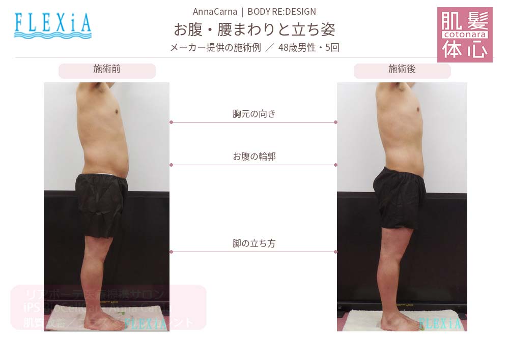 FTIナノカレントビフォーアフター写真｜美容家や芸能人ご用達・幹細胞コスメブランド・リアボーテ専門エステ・リアボーテ医療提携サロン AnnaCarna・リアボーテクレアスキン化粧品・リアボーテグランスキン化粧品・リアボーテシェリースキン化粧品・エキスパートローション・リアムール化粧品・エクラボーテ美顔器・正規取扱店・高濃度ヒト幹細胞培養液・ヒト幹細胞培養液・フェイシャル・ips細胞・ナノカレント・微弱電流・コラーゲン生成・筋膜・血流改善・リンパ・自律神経・再生美容・フェイスデザイン・リフトアップ・小顔・たるみケア・ほうれい線・マリオネットライン・フェイスラインもたつき・二重あご・目の下たるみ・クマ・青クマ・茶クマ・黒クマ・シミ・シミ取り・肝斑・色素沈着・ニキビ・ニキビ跡・毛穴・開き毛穴・たるみ毛穴・赤み・くすみ・乾燥・敏感肌・乾燥小じわ・ハリ・ツヤ・肌質改善・エイジングケア・年齢肌・頭活・頭皮ケア・育毛ケア・口コミ・評判・効果・使い方・ビフォーアフター・症例・動画・写真・施術方法・スキンケア方法・予約・当日予約・空き状況・料金・価格・体験・初回・再来・コース・メニュー・比較・おすすめ・人気・購入方法・販売店・正規販売・オンラインカウンセリング・発送対応・通販・ネット販売・禁止・対象外商品・カウンセリング必須・医療提携・専門サロン・完全個室・都度払い・勧誘なし・症例多数・実績・紹介・青山・港区・外苑前・東京・大阪・阿倍野区