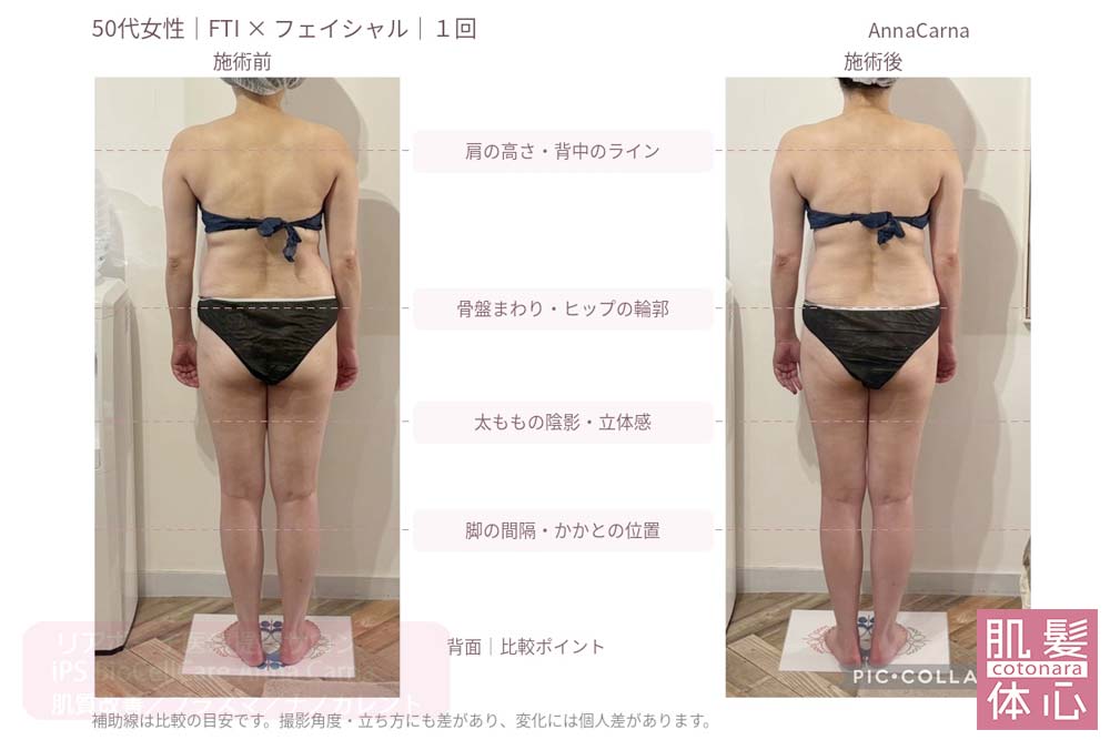 50代女性・FTIとフェイシャル１回の施術前後を後ろ姿で比較｜美容家や芸能人ご用達・幹細胞コスメブランド・リアボーテ専門エステ・リアボーテ医療提携サロン AnnaCarna・リアボーテクレアスキン化粧品・リアボーテグランスキン化粧品・リアボーテシェリースキン化粧品・エキスパートローション・リアムール化粧品・エクラボーテ美顔器・正規取扱店・高濃度ヒト幹細胞培養液・ヒト幹細胞培養液・フェイシャル・ips細胞・ナノカレント・微弱電流・コラーゲン生成・筋膜・血流改善・リンパ・自律神経・再生美容・フェイスデザイン・リフトアップ・小顔・たるみケア・ほうれい線・マリオネットライン・フェイスラインもたつき・二重あご・目の下たるみ・クマ・青クマ・茶クマ・黒クマ・シミ・シミ取り・肝斑・色素沈着・ニキビ・ニキビ跡・毛穴・開き毛穴・たるみ毛穴・赤み・くすみ・乾燥・敏感肌・乾燥小じわ・ハリ・ツヤ・肌質改善・エイジングケア・年齢肌・頭活・頭皮ケア・育毛ケア・口コミ・評判・効果・使い方・ビフォーアフター・症例・動画・写真・施術方法・スキンケア方法・予約・当日予約・空き状況・料金・価格・体験・初回・再来・コース・メニュー・比較・おすすめ・人気・購入方法・販売店・正規販売・オンラインカウンセリング・発送対応・通販・ネット販売・禁止・対象外商品・カウンセリング必須・医療提携・専門サロン・完全個室・都度払い・勧誘なし・症例多数・実績・紹介・青山・港区・外苑前・東京・大阪・阿倍野区