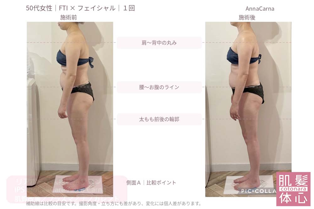 50代女性・FTIとフェイシャル１回の施術前後を横姿で比較｜美容家や芸能人ご用達・幹細胞コスメブランド・リアボーテ専門エステ・リアボーテ医療提携サロン AnnaCarna・リアボーテクレアスキン化粧品・リアボーテグランスキン化粧品・リアボーテシェリースキン化粧品・エキスパートローション・リアムール化粧品・エクラボーテ美顔器・正規取扱店・高濃度ヒト幹細胞培養液・ヒト幹細胞培養液・フェイシャル・ips細胞・ナノカレント・微弱電流・コラーゲン生成・筋膜・血流改善・リンパ・自律神経・再生美容・フェイスデザイン・リフトアップ・小顔・たるみケア・ほうれい線・マリオネットライン・フェイスラインもたつき・二重あご・目の下たるみ・クマ・青クマ・茶クマ・黒クマ・シミ・シミ取り・肝斑・色素沈着・ニキビ・ニキビ跡・毛穴・開き毛穴・たるみ毛穴・赤み・くすみ・乾燥・敏感肌・乾燥小じわ・ハリ・ツヤ・肌質改善・エイジングケア・年齢肌・頭活・頭皮ケア・育毛ケア・口コミ・評判・効果・使い方・ビフォーアフター・症例・動画・写真・施術方法・スキンケア方法・予約・当日予約・空き状況・料金・価格・体験・初回・再来・コース・メニュー・比較・おすすめ・人気・購入方法・販売店・正規販売・オンラインカウンセリング・発送対応・通販・ネット販売・禁止・対象外商品・カウンセリング必須・医療提携・専門サロン・完全個室・都度払い・勧誘なし・症例多数・実績・紹介・青山・港区・外苑前・東京・大阪・阿倍野区