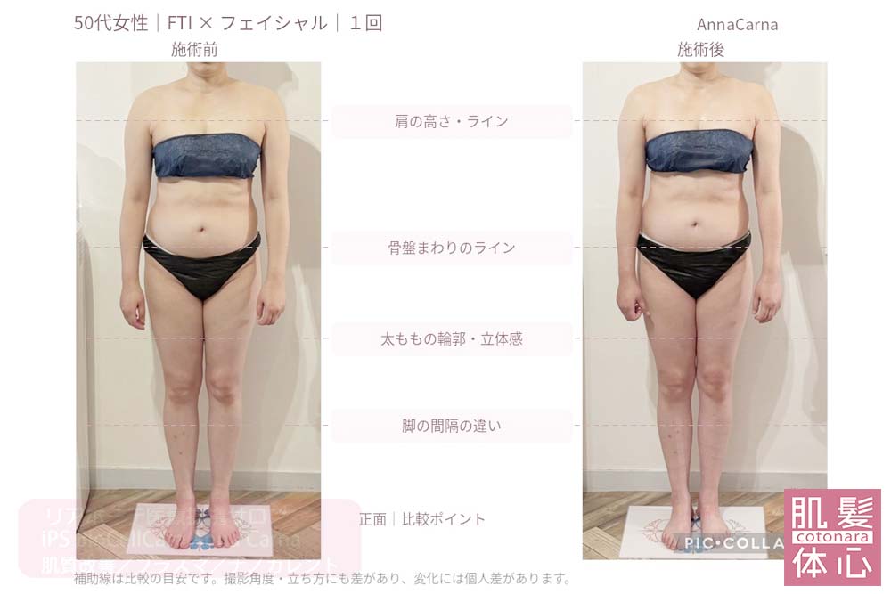 50代女性・FTIとフェイシャル１回の施術前後を正面で比較｜美容家や芸能人ご用達・幹細胞コスメブランド・リアボーテ専門エステ・リアボーテ医療提携サロン AnnaCarna・リアボーテクレアスキン化粧品・リアボーテグランスキン化粧品・リアボーテシェリースキン化粧品・エキスパートローション・リアムール化粧品・エクラボーテ美顔器・正規取扱店・高濃度ヒト幹細胞培養液・ヒト幹細胞培養液・フェイシャル・ips細胞・ナノカレント・微弱電流・コラーゲン生成・筋膜・血流改善・リンパ・自律神経・再生美容・フェイスデザイン・リフトアップ・小顔・たるみケア・ほうれい線・マリオネットライン・フェイスラインもたつき・二重あご・目の下たるみ・クマ・青クマ・茶クマ・黒クマ・シミ・シミ取り・肝斑・色素沈着・ニキビ・ニキビ跡・毛穴・開き毛穴・たるみ毛穴・赤み・くすみ・乾燥・敏感肌・乾燥小じわ・ハリ・ツヤ・肌質改善・エイジングケア・年齢肌・頭活・頭皮ケア・育毛ケア・口コミ・評判・効果・使い方・ビフォーアフター・症例・動画・写真・施術方法・スキンケア方法・予約・当日予約・空き状況・料金・価格・体験・初回・再来・コース・メニュー・比較・おすすめ・人気・購入方法・販売店・正規販売・オンラインカウンセリング・発送対応・通販・ネット販売・禁止・対象外商品・カウンセリング必須・医療提携・専門サロン・完全個室・都度払い・勧誘なし・症例多数・実績・紹介・青山・港区・外苑前・東京・大阪・阿倍野区