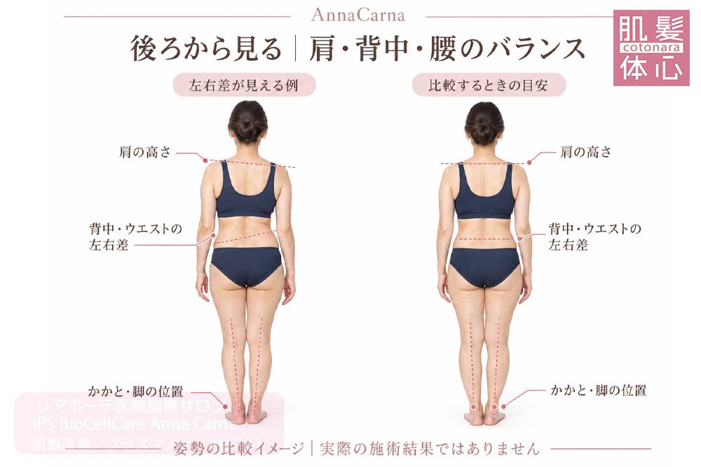 後ろ姿から肩・背中・腰・かかとの左右差を見る説明イラスト｜美容家や芸能人ご用達・幹細胞コスメブランド・リアボーテ専門エステ・リアボーテ医療提携サロン AnnaCarna・リアボーテクレアスキン化粧品・リアボーテグランスキン化粧品・リアボーテシェリースキン化粧品・エキスパートローション・リアムール化粧品・エクラボーテ美顔器・正規取扱店・高濃度ヒト幹細胞培養液・ヒト幹細胞培養液・フェイシャル・ips細胞・ナノカレント・微弱電流・コラーゲン生成・筋膜・血流改善・リンパ・自律神経・再生美容・フェイスデザイン・リフトアップ・小顔・たるみケア・ほうれい線・マリオネットライン・フェイスラインもたつき・二重あご・目の下たるみ・クマ・青クマ・茶クマ・黒クマ・シミ・シミ取り・肝斑・色素沈着・ニキビ・ニキビ跡・毛穴・開き毛穴・たるみ毛穴・赤み・くすみ・乾燥・敏感肌・乾燥小じわ・ハリ・ツヤ・肌質改善・エイジングケア・年齢肌・頭活・頭皮ケア・育毛ケア・口コミ・評判・効果・使い方・ビフォーアフター・症例・動画・写真・施術方法・スキンケア方法・予約・当日予約・空き状況・料金・価格・体験・初回・再来・コース・メニュー・比較・おすすめ・人気・購入方法・販売店・正規販売・オンラインカウンセリング・発送対応・通販・ネット販売・禁止・対象外商品・カウンセリング必須・医療提携・専門サロン・完全個室・都度払い・勧誘なし・症例多数・実績・紹介・青山・港区・外苑前・東京・大阪・阿倍野区
