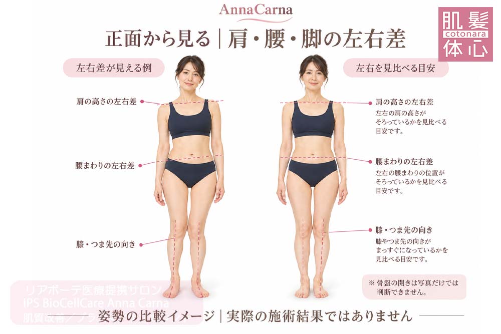 正面から肩の高さ・腰まわり・膝とつま先の向きを比較する説明イラスト｜美容家や芸能人ご用達・幹細胞コスメブランド・リアボーテ専門エステ・リアボーテ医療提携サロン AnnaCarna・リアボーテクレアスキン化粧品・リアボーテグランスキン化粧品・リアボーテシェリースキン化粧品・エキスパートローション・リアムール化粧品・エクラボーテ美顔器・正規取扱店・高濃度ヒト幹細胞培養液・ヒト幹細胞培養液・フェイシャル・ips細胞・ナノカレント・微弱電流・コラーゲン生成・筋膜・血流改善・リンパ・自律神経・再生美容・フェイスデザイン・リフトアップ・小顔・たるみケア・ほうれい線・マリオネットライン・フェイスラインもたつき・二重あご・目の下たるみ・クマ・青クマ・茶クマ・黒クマ・シミ・シミ取り・肝斑・色素沈着・ニキビ・ニキビ跡・毛穴・開き毛穴・たるみ毛穴・赤み・くすみ・乾燥・敏感肌・乾燥小じわ・ハリ・ツヤ・肌質改善・エイジングケア・年齢肌・頭活・頭皮ケア・育毛ケア・口コミ・評判・効果・使い方・ビフォーアフター・症例・動画・写真・施術方法・スキンケア方法・予約・当日予約・空き状況・料金・価格・体験・初回・再来・コース・メニュー・比較・おすすめ・人気・購入方法・販売店・正規販売・オンラインカウンセリング・発送対応・通販・ネット販売・禁止・対象外商品・カウンセリング必須・医療提携・専門サロン・完全個室・都度払い・勧誘なし・症例多数・実績・紹介・青山・港区・外苑前・東京・大阪・阿倍野区